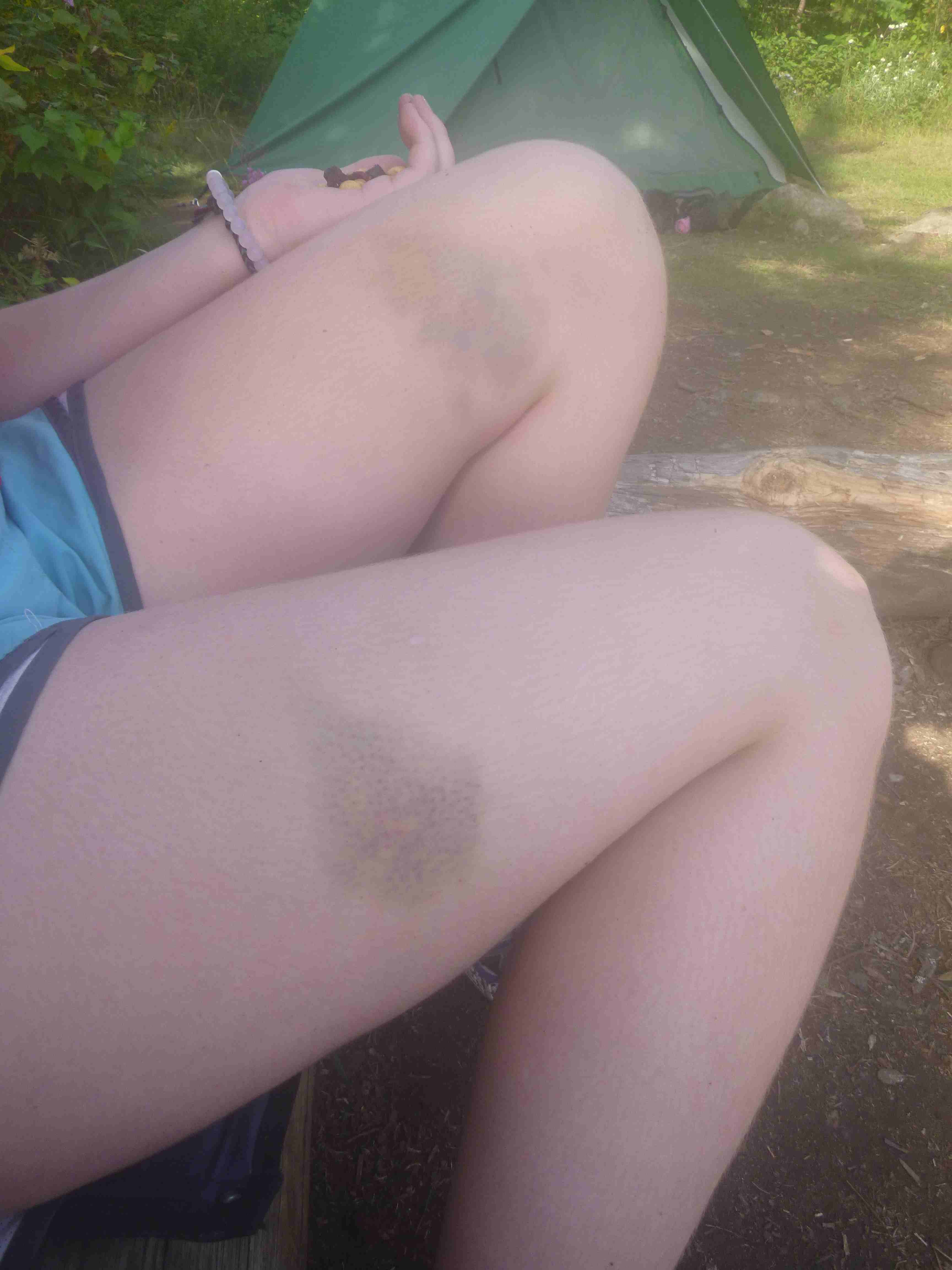 2016-08-09 BWCWA bruises.jpg